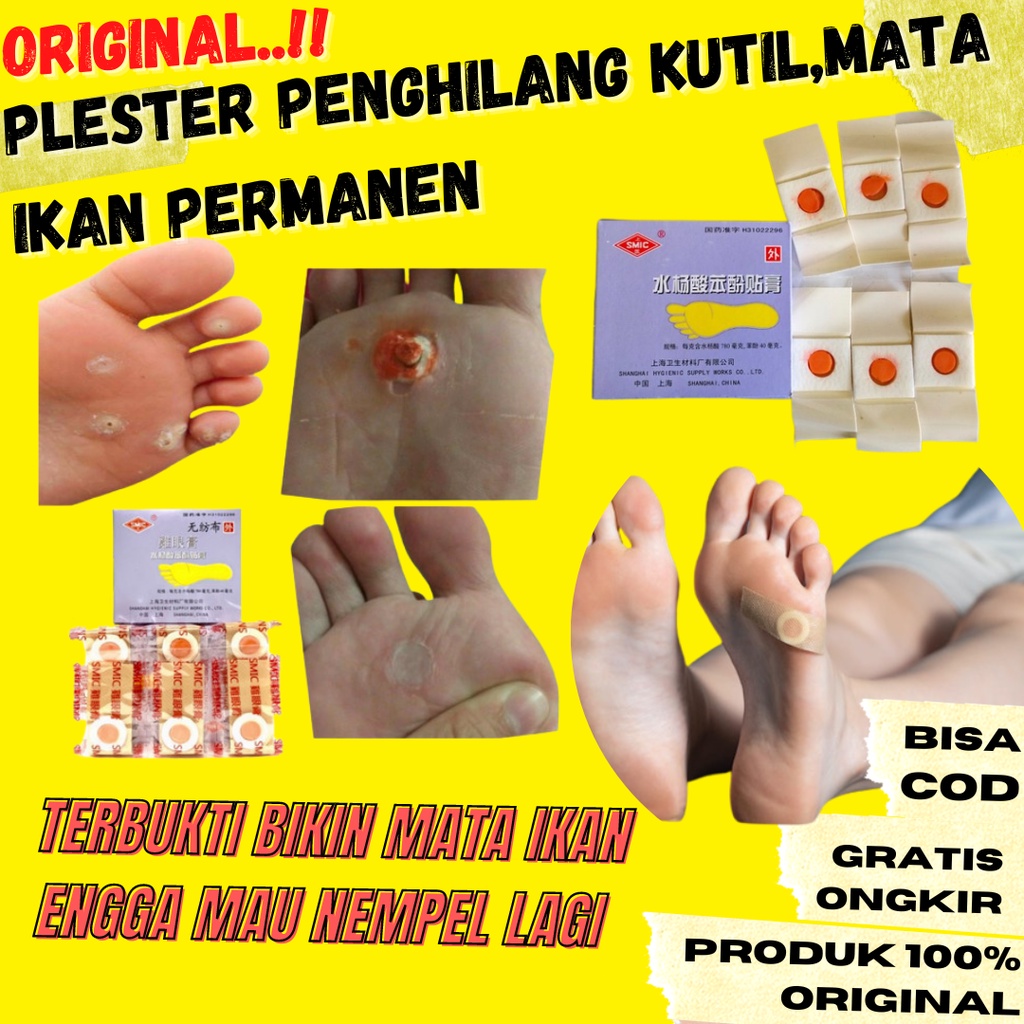 ORIGINAL Ji Yan Gao Plaster Kutil - Mata Ikan - Plester Kutil/Mata Ikan DLL -1box isi 6pcs