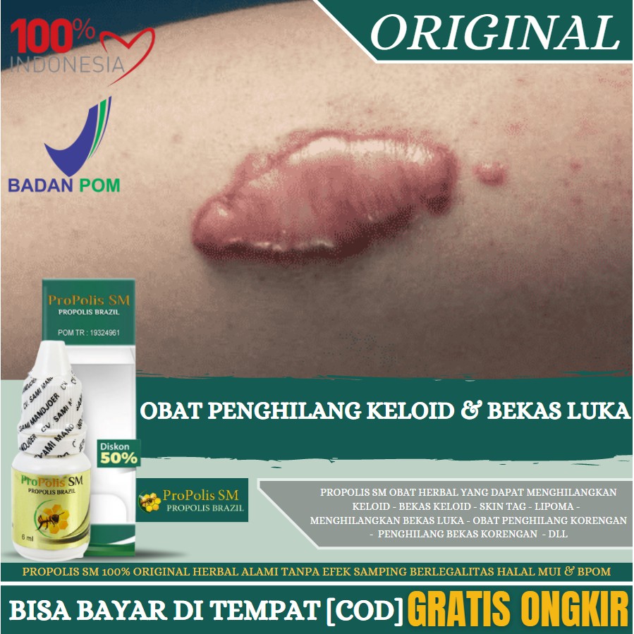 Obat Keloid, Penghilang Bekas Keloid, Korengan, Bekas Luka Menonjol Tanpa Bekas,Propolis SM Original
