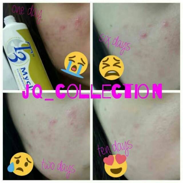 Obat jerawat / T3 mycin