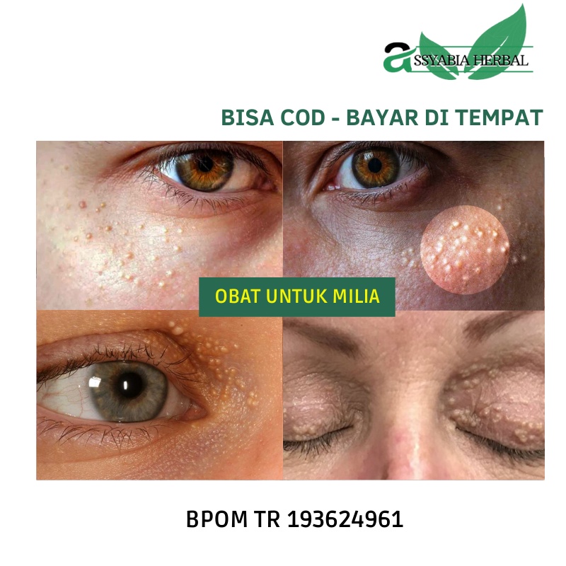 Obat Milea Dekat Mata Pada Wajah Bintik di Bawah Mata Milia di Kelopak Mata di Hidung di Bibir Wajah