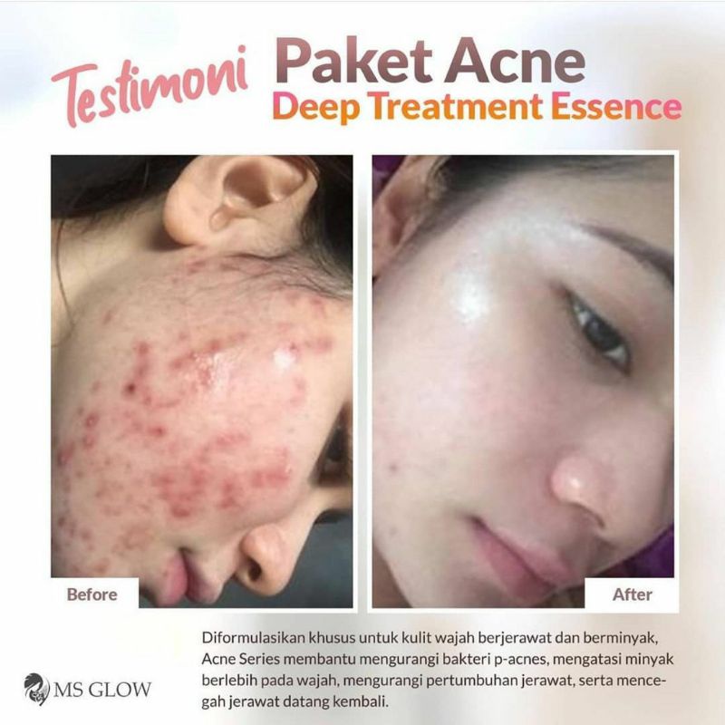 MS GLOW ORI Skin Care Acne Series Termurah BerBPOM Promo Paket Kecantikan MS Glow Termurah