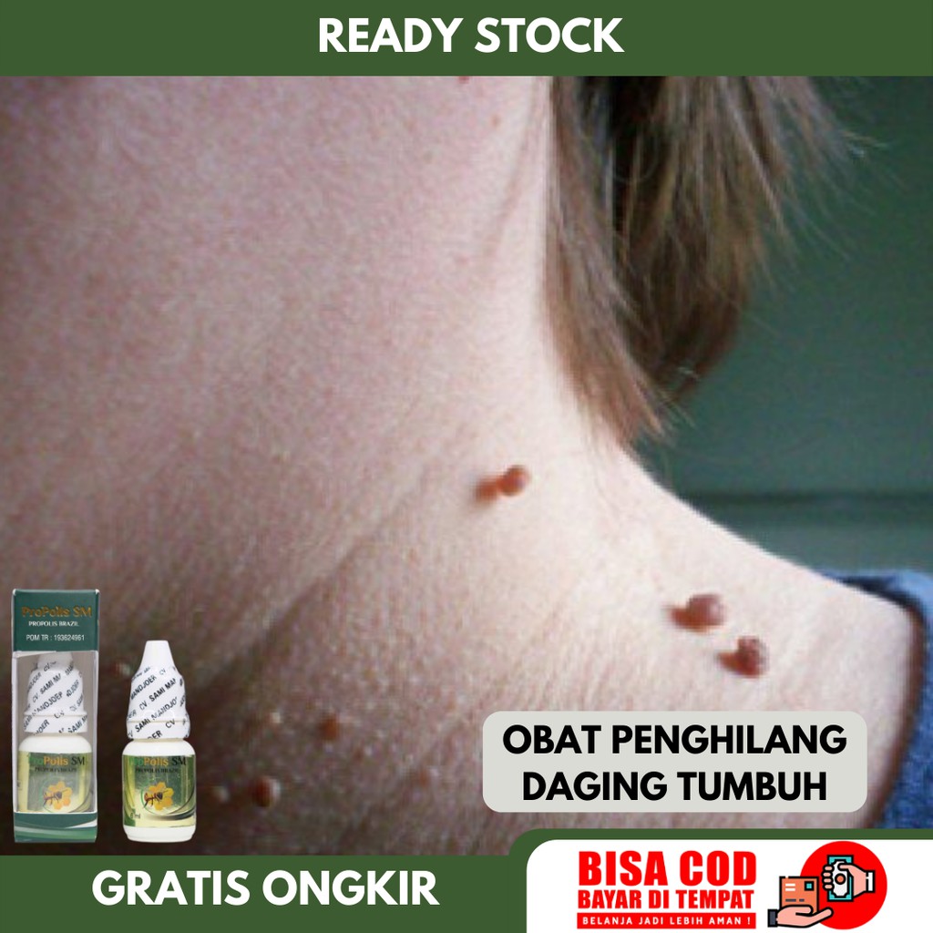 Obat Daging Tumbuh - Penghilang Skin Tag, Daging Jadi Menahun, Obat Pengelupas Benjolan Kecil, Mata 