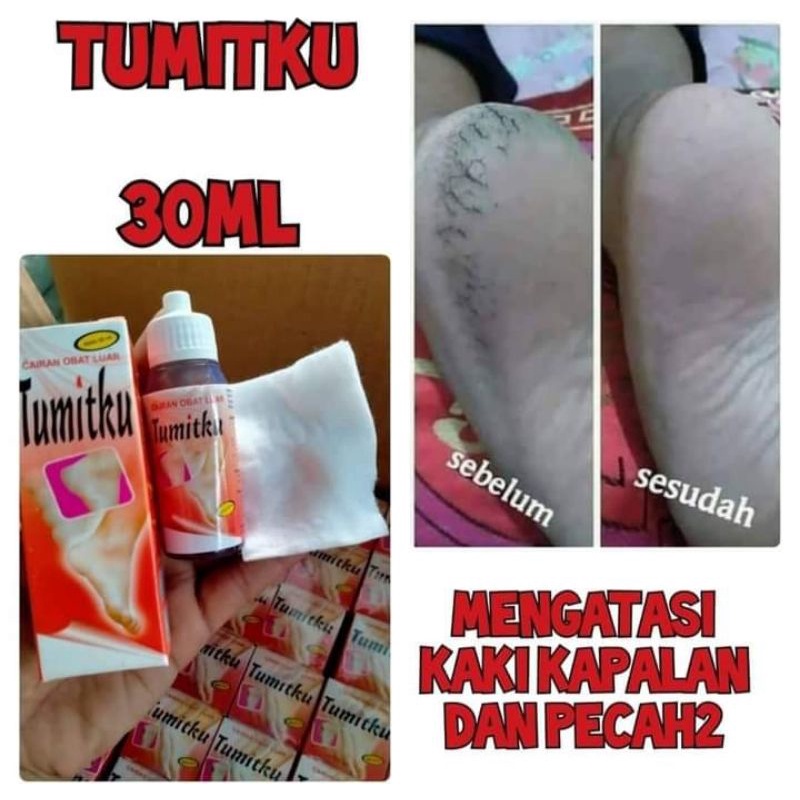 TUMITKU OBAT TUMIT PECAH-PECAH
