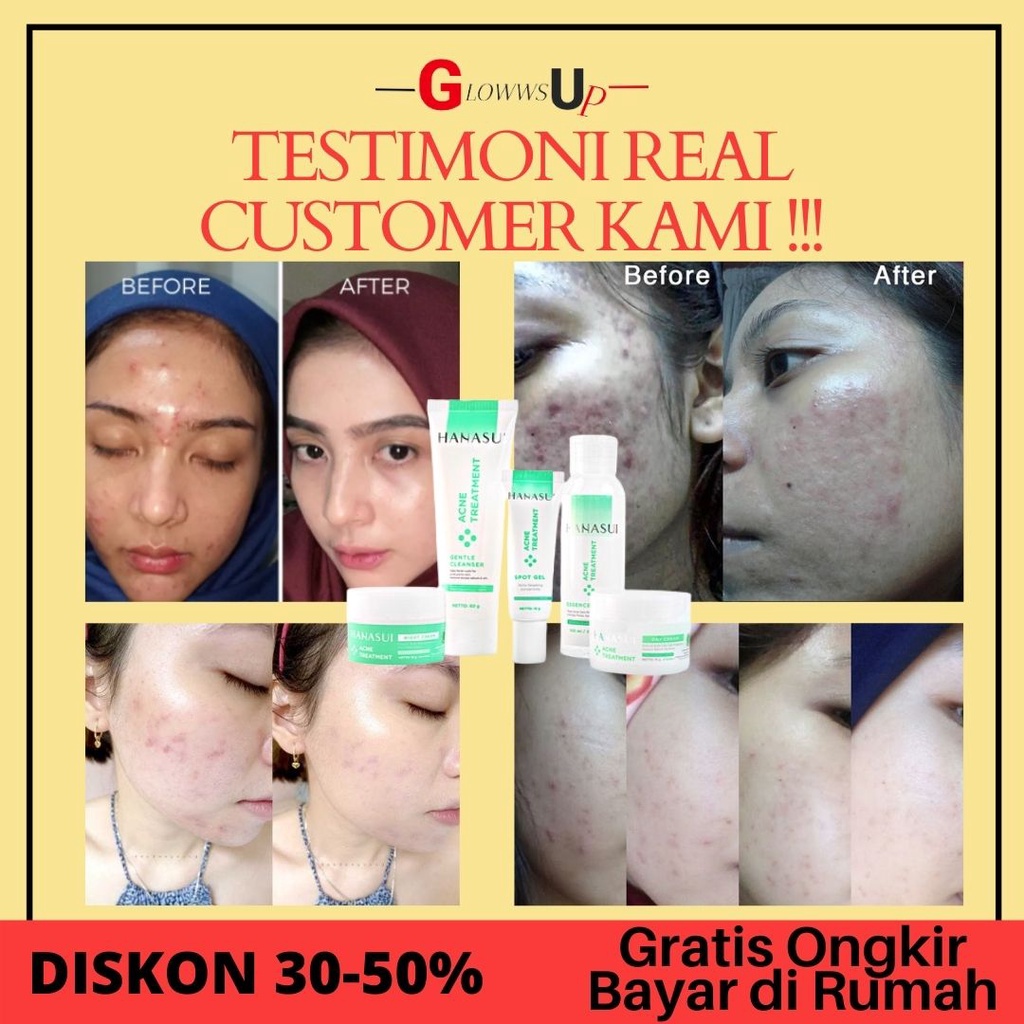 PENGHILANG JERAWAT HANASUI ACNE TREATMENT PAKET 5IN1 ORIGINAL BPOM CREAM ACNE HANASUI CREAM BEKAS JERAWAT KRIM JERAWAT SKINCARE ACNE PERAWATAN JERAWAT