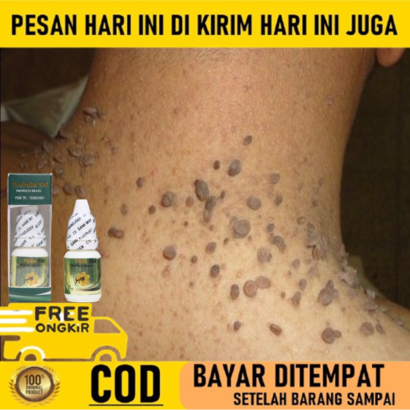 Obat Papiloma leher - Penghilang kutil leher - Obat Kutil di wajah - papiloma di leher - Obat Kutil 