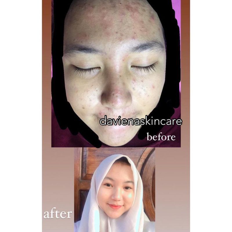 Night Cream Daviena Acne Series Daviena Skincare Deviena Davina Devina Skincare Official Davienaskincareofficial Palembang ori Ramadhanidavin official Ownerdavienaskincare Pencerah Wajah Glowing Bpom Davienaskincare jawa jakarta scincare Skincare