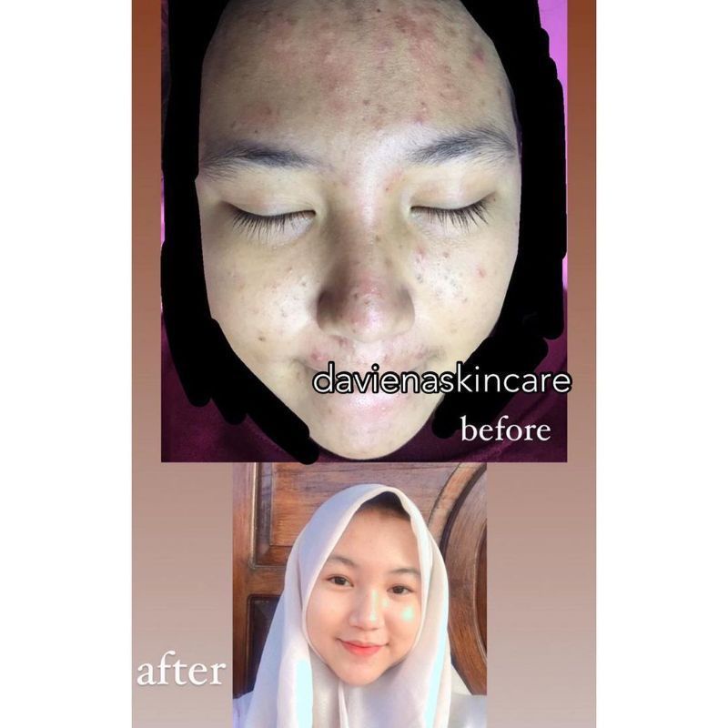 Night Cream Acne Daviena Skincare Davienaskincareofficial Davina Devina Daviena