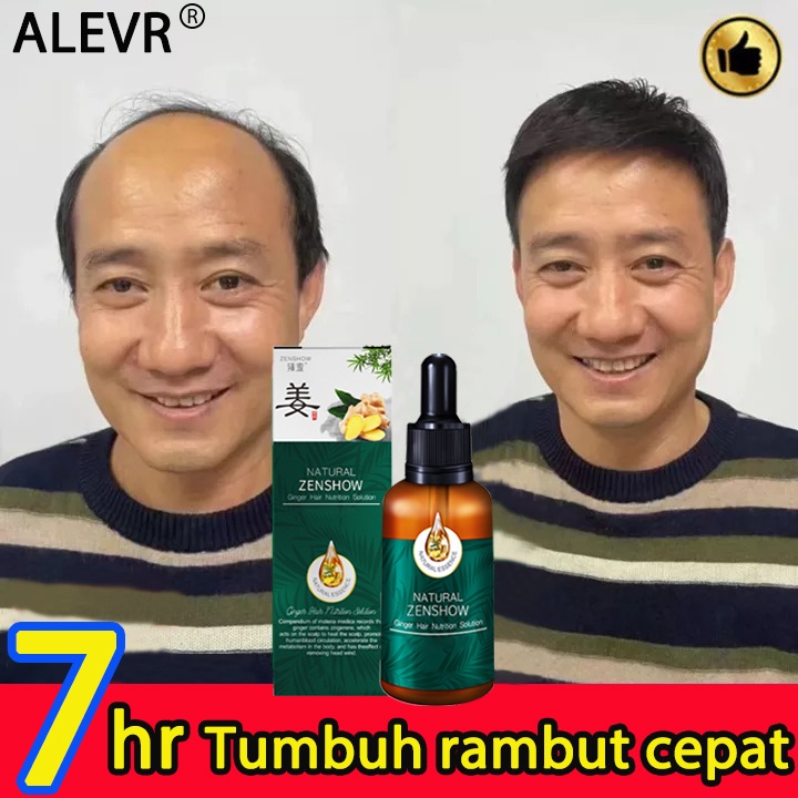 Jual PROMO TERMURAH PENUMBUH RAMBUT Cairan Essence Penumbuh Rambut Anti ...