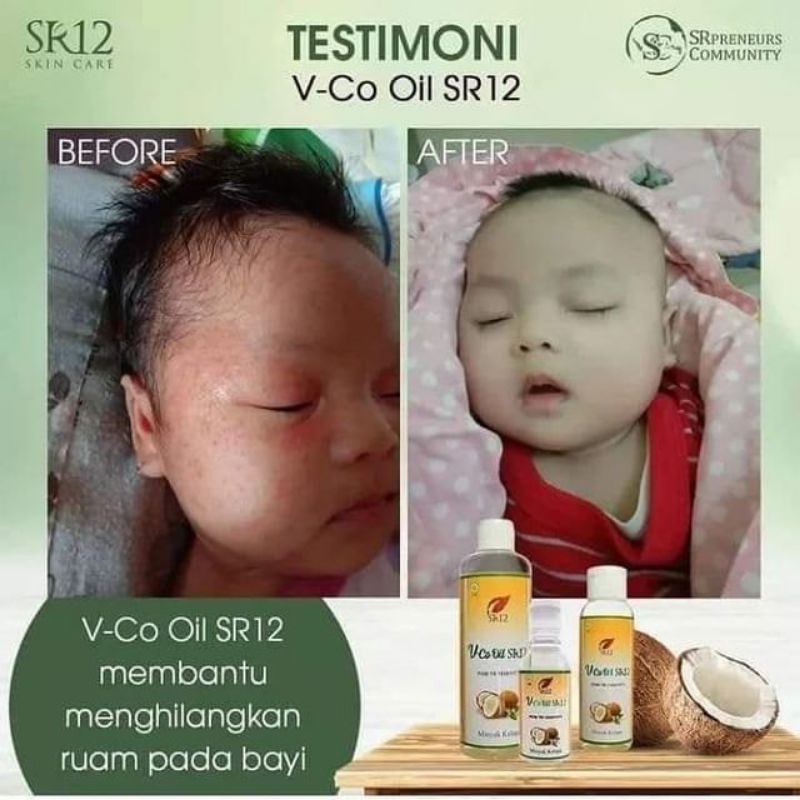 VCO SR12 Untuk Bayi VCO untuk ruam pada bayi VCO Oil Original BPOM