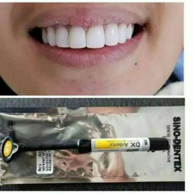 Composite denteX EXW composit