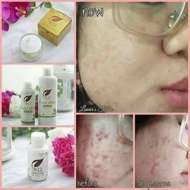 Acne treatment sr12