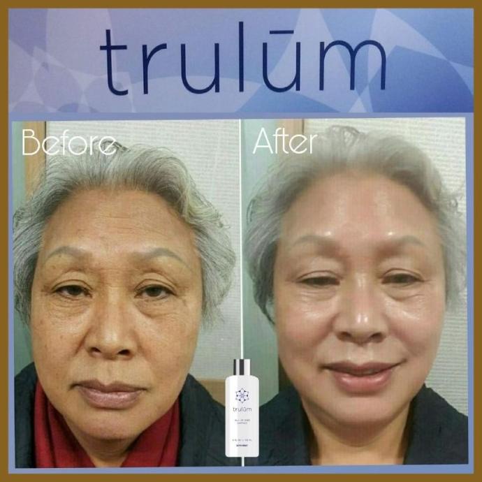 Penghilang Bekas Jerawat - Cream Krim Wajah Kusam Pemutih Wajah Penghilang Keriput | Trulum 15Ml