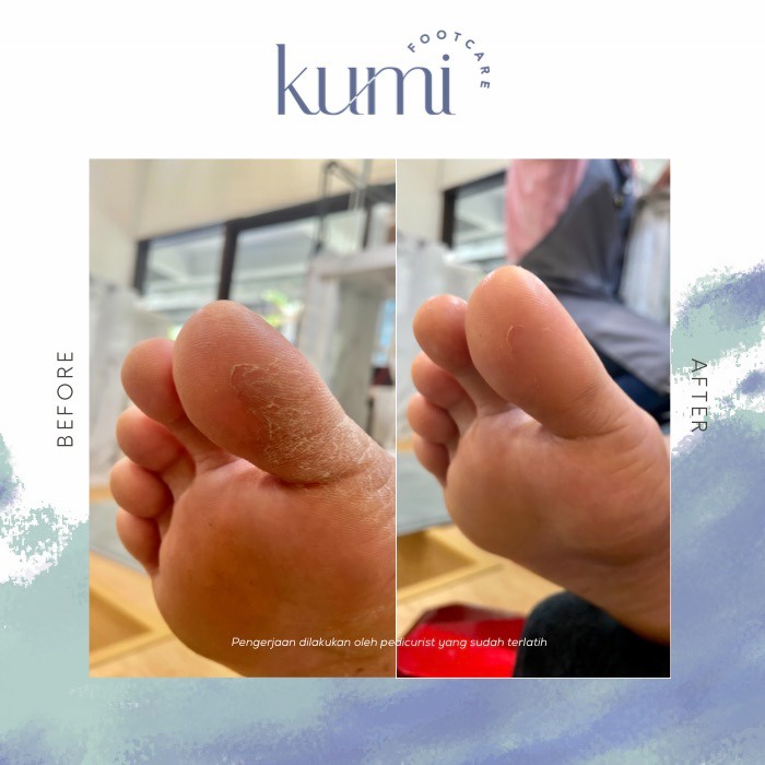 Kumi PEDIDAY DEEPCLEAN Package /  Pedicure / Callus Treatment