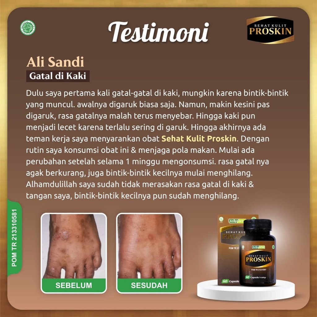 Penghilang Gatal di Punggung Panu Kurap Paling Alami Obat Alergi Gatel Kulit Herbal Penghilang Jerawat Biduran Bintik Gatel Jamur Kulit Benjolan Suplemen Kesehatan Ekstrak Binahong PROSKIN Tanpa Efek Samping Salep Cream Alat Pijat Garuk Menggaruk Punggung-6