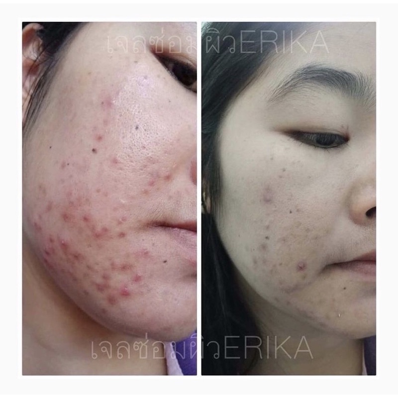 🇹🇭 Erika Skin Repair Gel 42ml / pelembab dan eye cream kulit jerawat / anti acne