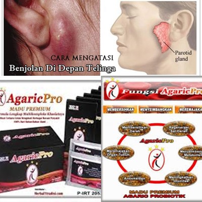 Obat Herbal Sakit Benjolan Dibawah Telinga Dileher Pada Anak Dewasa Yang Aman Ampuh Tanpa Operasi Shopee Indonesia