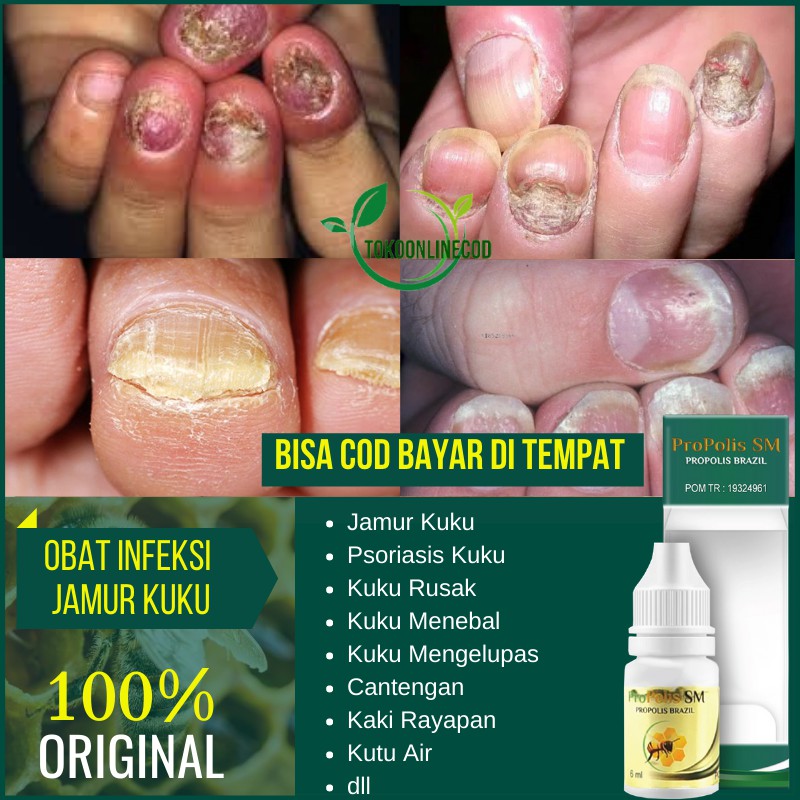 Obat Jamur Kuku Psoriasis Kuku Rusak Jamur Kuku Kaki Tangan Pitting Kuku Menebal Rapuh Bergelombang
