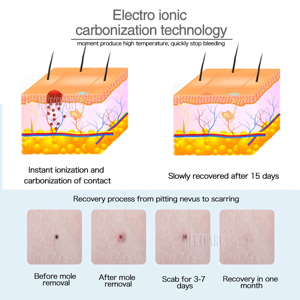 Laser penghilang tahi lalat kutil tato tanda lahir toh Mole Tatto Dark Spot Remover alat kecantikan Laser Face Skin Mole Removal Machine Tattoo Plasma Remove Pen Face Dark Spot Freckle Tag Wart Remover Beauty Device skin care