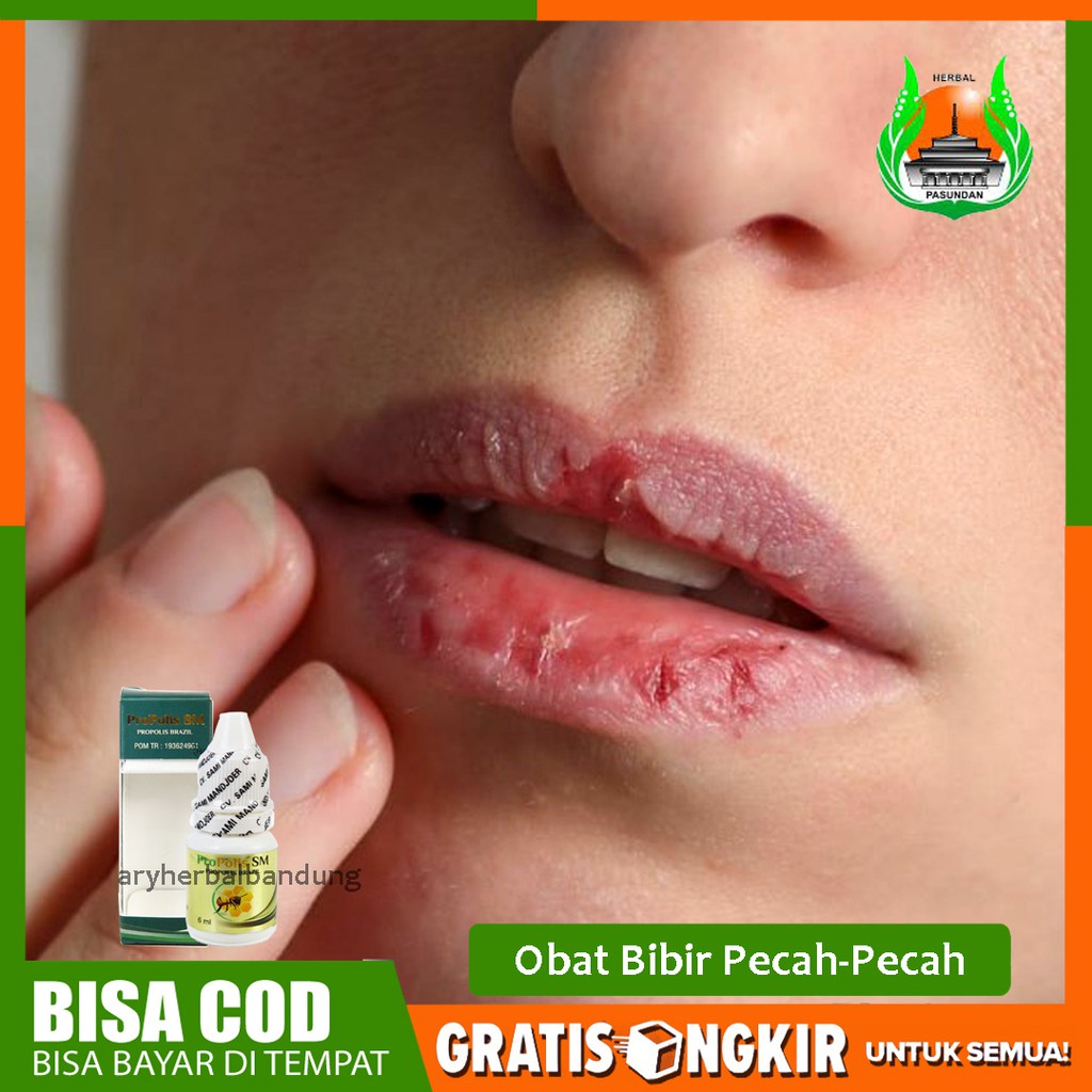 Obat Bibir Pecah Pecah Sariawan Luka Di Mulut Herbal Alami Murah Propolis Sm Original Bisa Cod Shopee Indonesia