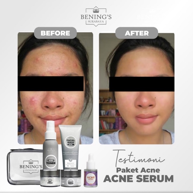 BENING'S PAKET ACNE | MENGATASI MASALAH JERAWAT, BRUNTUSAN &amp; MENCERAHKAN