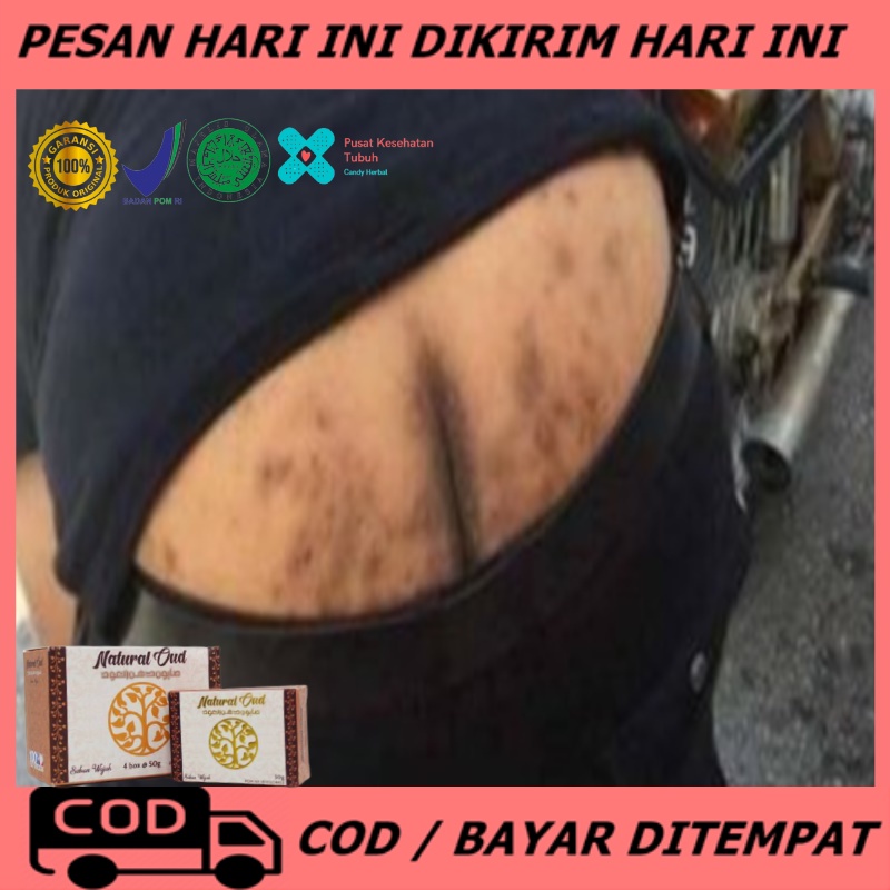 Sabun penghilang bekas luka, Sabun penghilang bekas luka hitam koreng, Obat gatal pantat, Sabun jera
