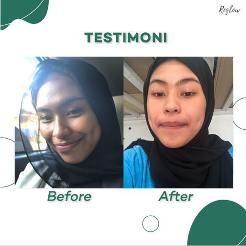 REGLOW Paket Skincare Original Asli | Perawatan Kecantikan Wajah Glowing | Glow Skin Treatment | Atasi Muka Jerawat Flek Hitam Milia Kusam | Skin Care BPOM Halal MUI | Sunscreen Whitening Anti-Aging | Aman Bumil Busui-3