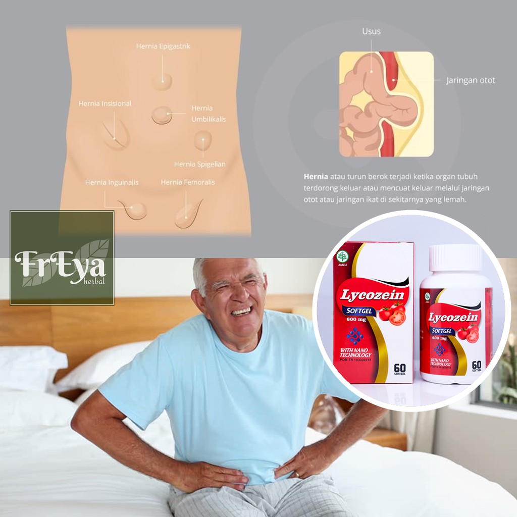 OBAT HERNIA, OBAT HERBAL TURUN BEROK, OBAT USUS TURUN (BISA COD)