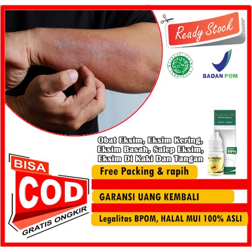 Obat Eksim, Eksim Kering, Eksim Basah, Salep Eksim, Eksim Di Kaki Dan Tangan, Eksim Menahun, Gatal K