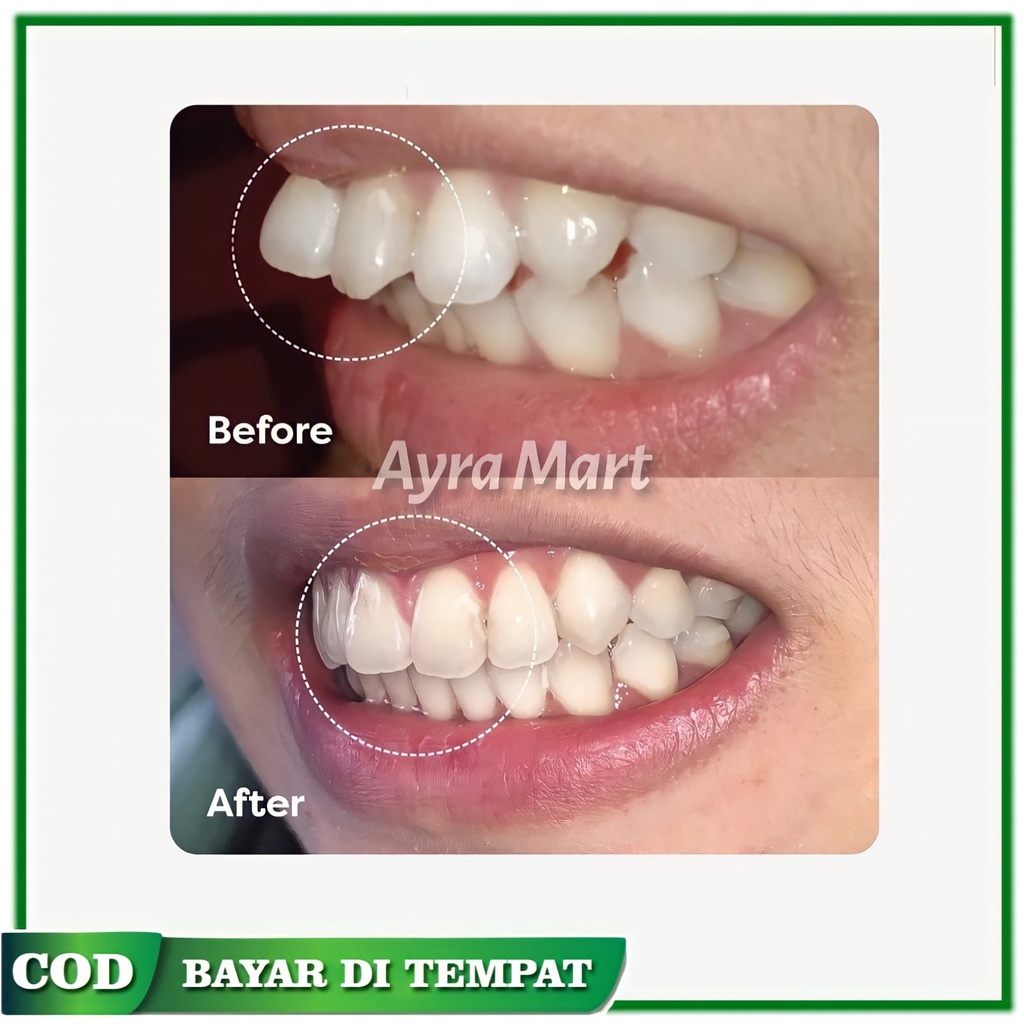 Perata gigi Perawatan gigi Aligner perapih gigi Teeth trainer Perapih gigi original asli Alat perata