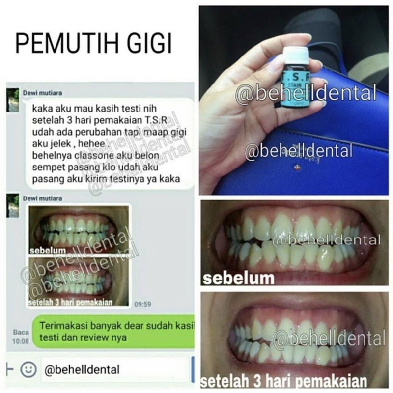 [ORI] PEMUTIH GIGI TSR AMPUH CEPAT TERBAIK PENGHANCUR PELUNAK KARANG PLAK OBAT PENGHILANG BAU MULUT