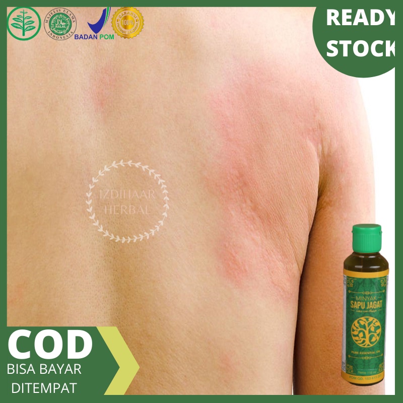 Obat alergi makanan, Obat gatal alergi, Obat alergi gatal kulit, Obat alergi, Salep gatal gatal, Oba