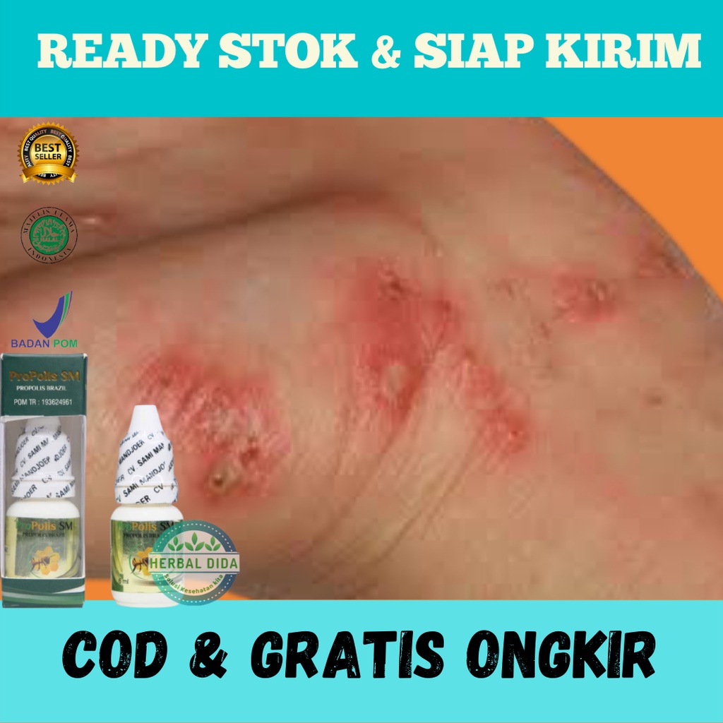 Obat Herbal Luka Borok, Obat Herbal Budug Menahun, Obat Herbal Jamur Kulit, Obat Budug di Kaki Santr
