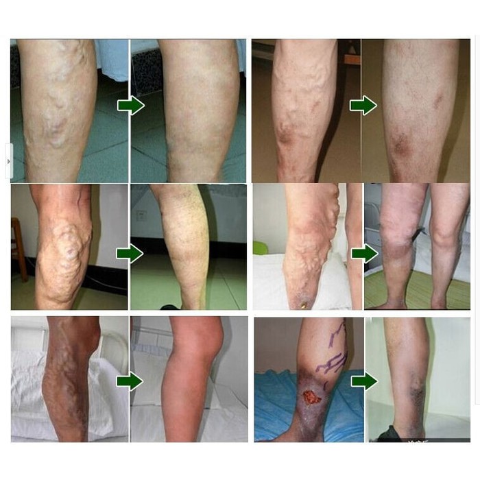 Salep Obat Penghilang Varises Kaki Paling Ampuh Original Varicose Veins Treatment Cream Krim Bpom