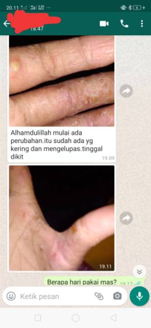 Salep BL Ampuh ASLI Original 100% | Obat Gatal | Salep Kulit Gatal | Obat Eksim Exim