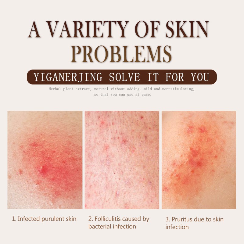 Yiganerjing 100% asli obat gatal dermatitis eksim psoriasis anti jamur bakteri gatel alergi salep-6