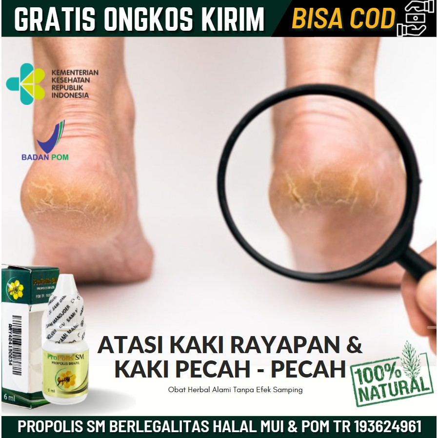 Obat Pitted Keratolysis / Kaki Rayap, Kaki Berlubang Lubang Lembab Tetapi Tidak Gatal, Propolis SM