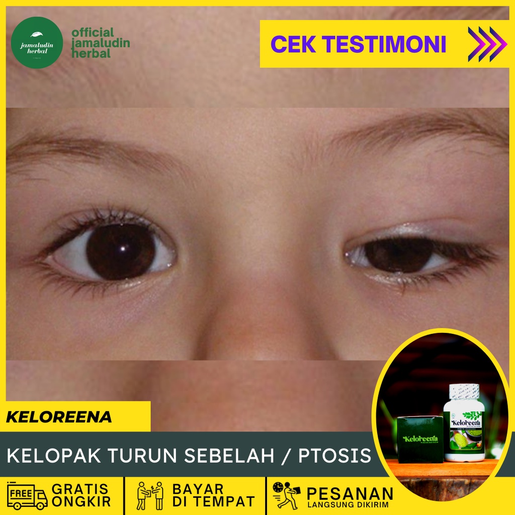 Obat untuk kelopak mata turun, Obat herbal mata ptosis, Obat mata sipit sebelah, Obat mata sipit seb