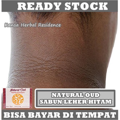 Sabun Penghilang Hitam Di Belakang Leher, Pemutih Daki Hitam Di Leher, Krim Leher Whitening Bpom, Perawatan Untuk Leher Hitam, Sabun Pembersih Leher Item, Sabun Buat Leher Hitam, Sabun Leher Hitam Herbal Natural Oud Asli 100% Original Berlegalitas BPOM