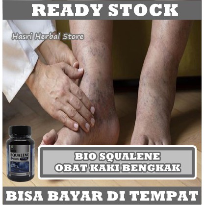 Obat Bengkak Di Tangan Dan Kaki, Edema Kaki Herbal, Obat Kaki Gajah, Obat Kaki Bengkak Alami, Kaki Memar, Obat Engkel Kaki Sakit Sebelah, Bengkak Di Pergelangan Kaki, Kaki Bengkak, Filariasis, Terkilir, Keseleo, Kaki Membengkak Dengan Bio Squalene ORI