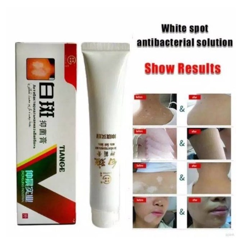 TIANGE Salep Vitiligo Bercak Putih Bahan Herbal Tiange Cream Original Ampuh