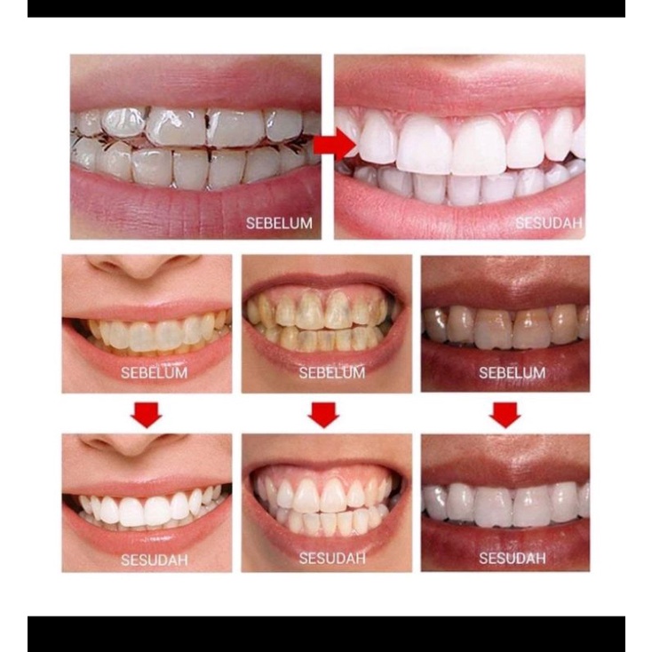 BREYLEE pemutih gigi