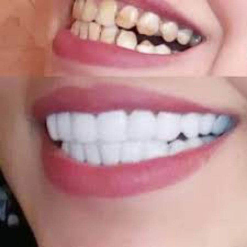 Snap On smile 1 pasang gigi palsu atas bawah 100% Original