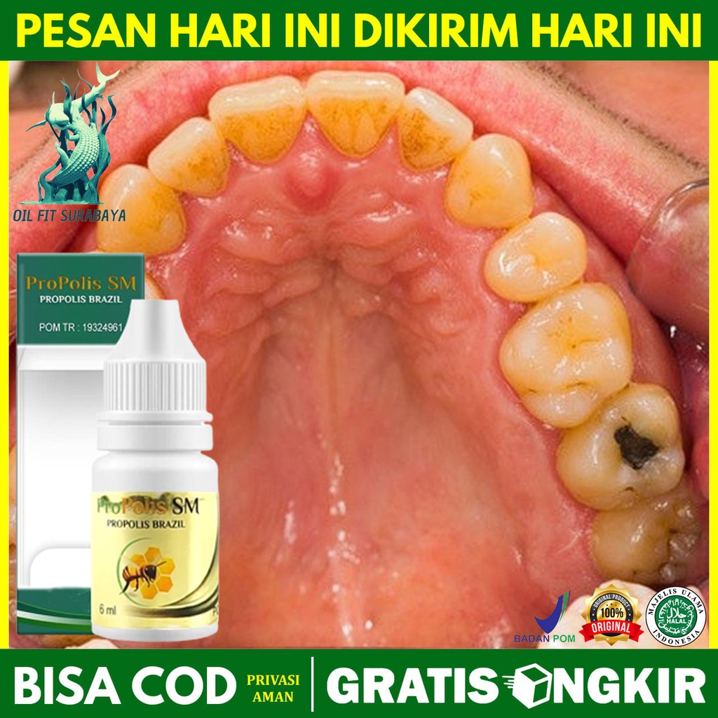 Obat Gigi Berlubang, Obat Gigi Bolong, Gigi Sering Nyut Nyutan, Gigi Ngilu, Plak Gigi, Gusi Bengkak,