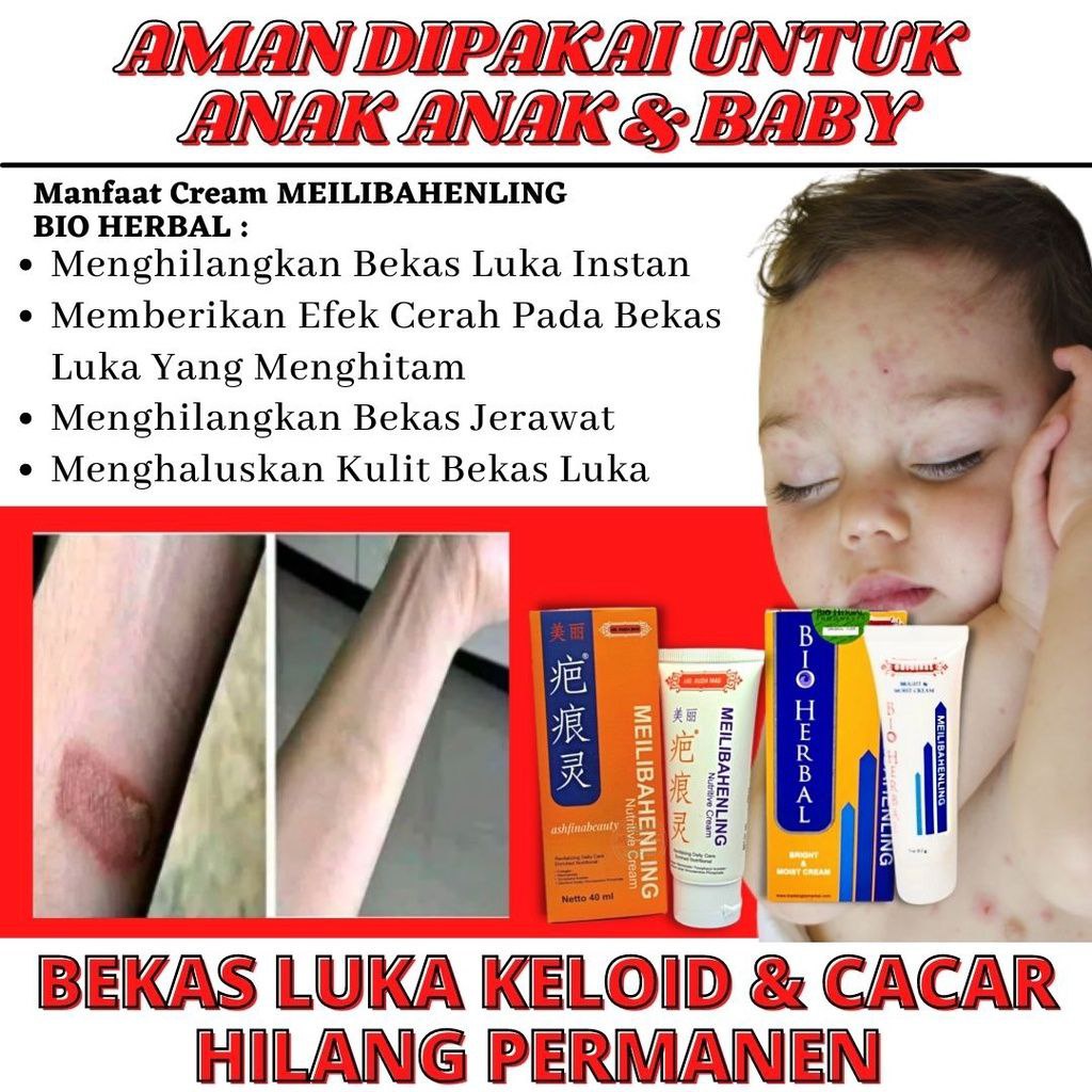 Obat Cream Penghilang Bekas Luka Lama Hitam Koreng Bopeng Jerawat Meilibahenling Original 100% Ampuh BPOM Resmi Mengobati Luka Kulit Asli Halal Berkhasiat Untuk Menghilangkan Semua Jenis Bekas Luka Yang Mengandung Bahan Natural Alami Tanpa Efek Samping