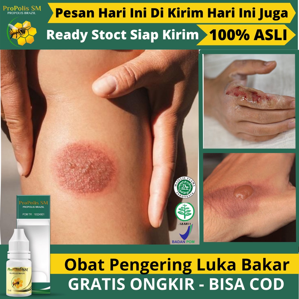 Obat Oles Untuk Luka Bakar Kena Knalpot - Obat Luka Bakar Agar Cepat Kering - Obat Luka Bakar Berair