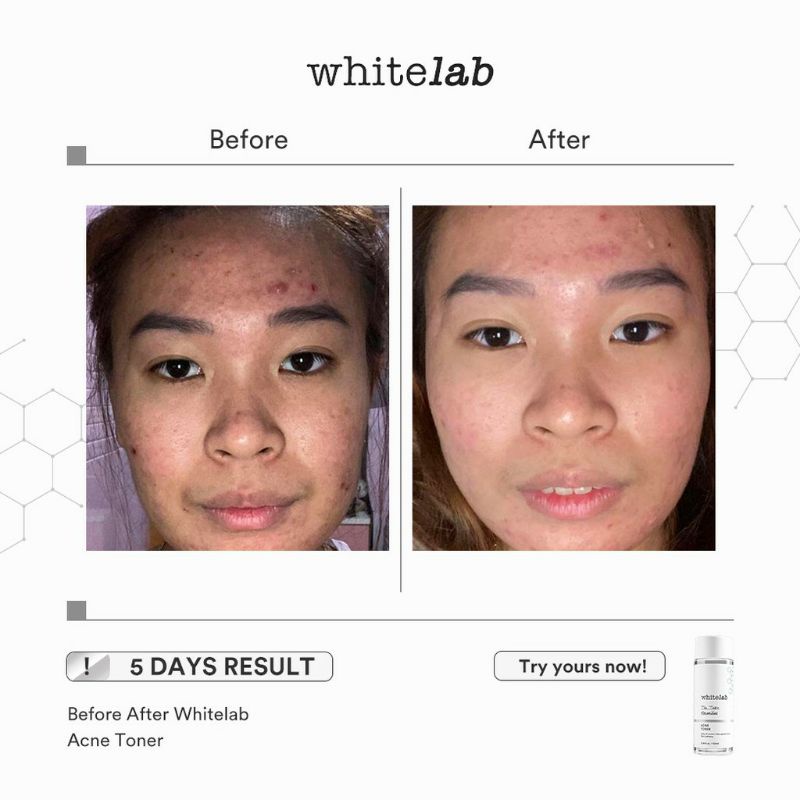 Whitelab Acne Toner 100mL