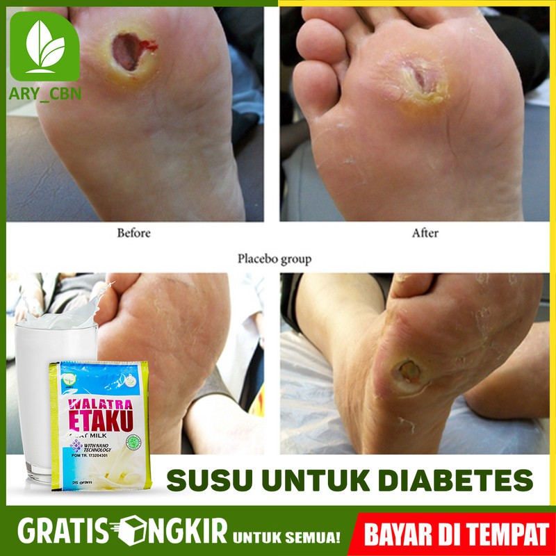 

Susu Untuk Diabetes - Diabet - Susu Penurun Penderita Diabetes Susu Kambing Murni Etaku di Cirebon