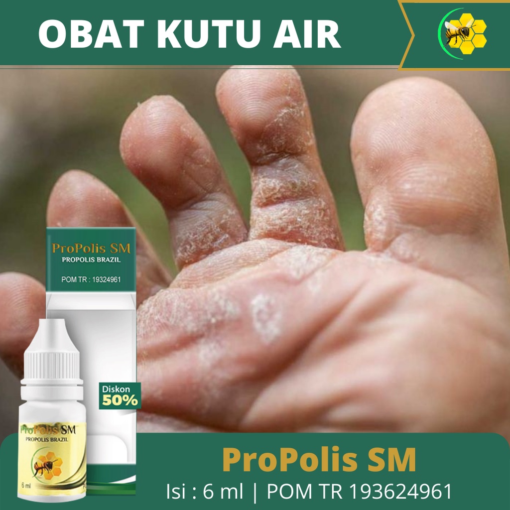 Jual Obat Penghilang Kutu Air Kutu Air Di Kaki Kutu Air Di Tangan Infeksi Jamur Infeksi 8996