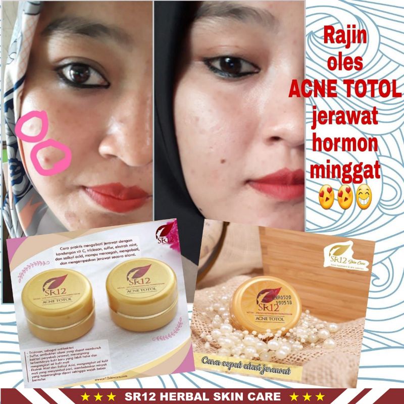 Skincare Wajah Berjerawat BPOM | Acne Series SR12 Skincare | Acne Moist | Acne Totol | Acne Serum | Acne Toner | Solusi Ampuh Atasi Jerawat | Menghilangkan Jerawat dan Bekas Jerawat | Krim Jerawat | Jerawat Bruntusan | Jerawat Batu | Jerawat Membandel