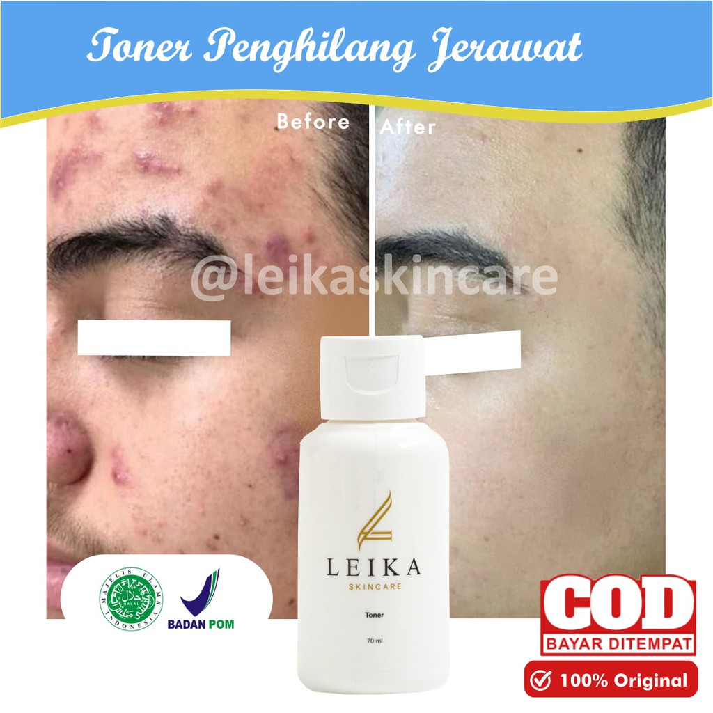 Toner Jerawat AMPUH Penghilang Jerawat Pria ASLI Perawatan Wajah Pria Terbaik Halal BPOM Toner Acne